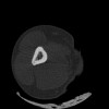 SPORK, NICO - 22.03.1976 - 02.08.2022 - CT obere Extremität - 17:51:17